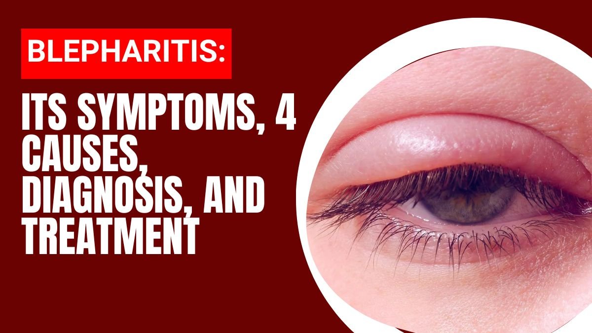 Blepharitis Symptoms 4 Causes Diagnosis And Treatment 